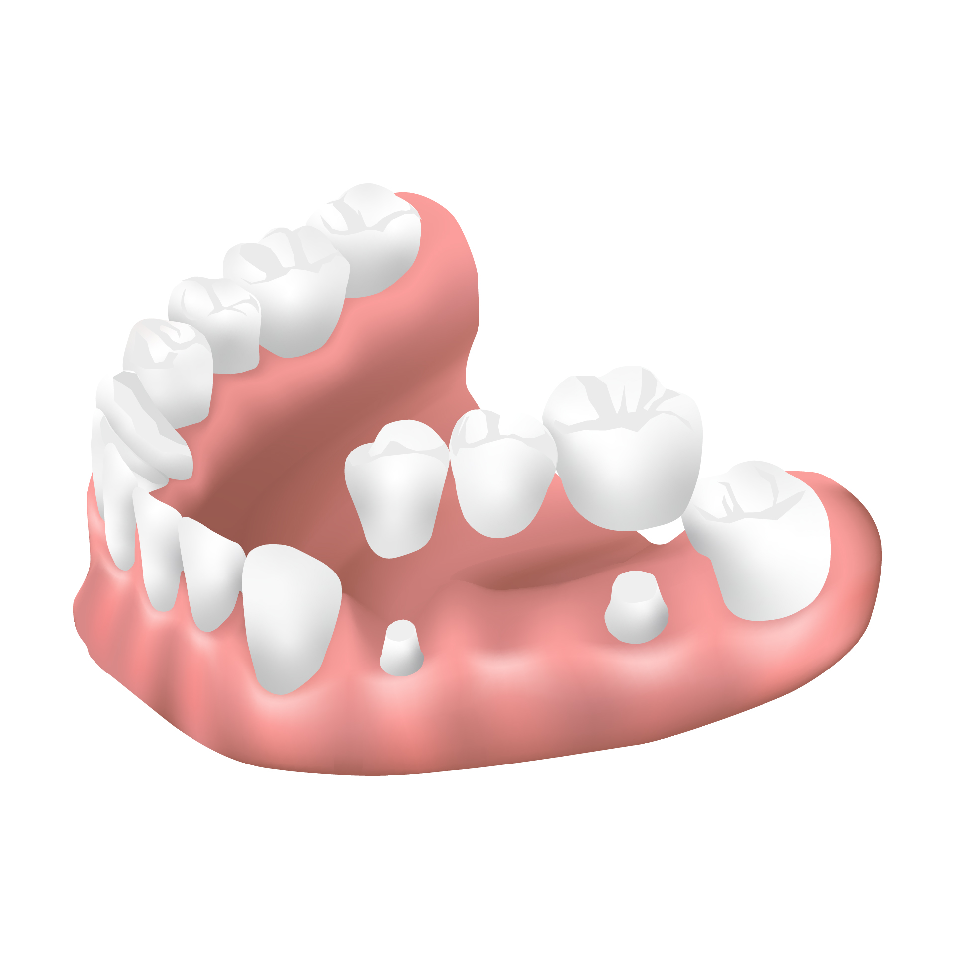 歯のブリッジ・九大学研都市・ないとうファミリー歯科