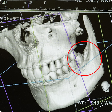 埋伏歯、横向きに埋まった親知らずの抜歯｜福岡県田尻のないとうファミリー歯科クリニック